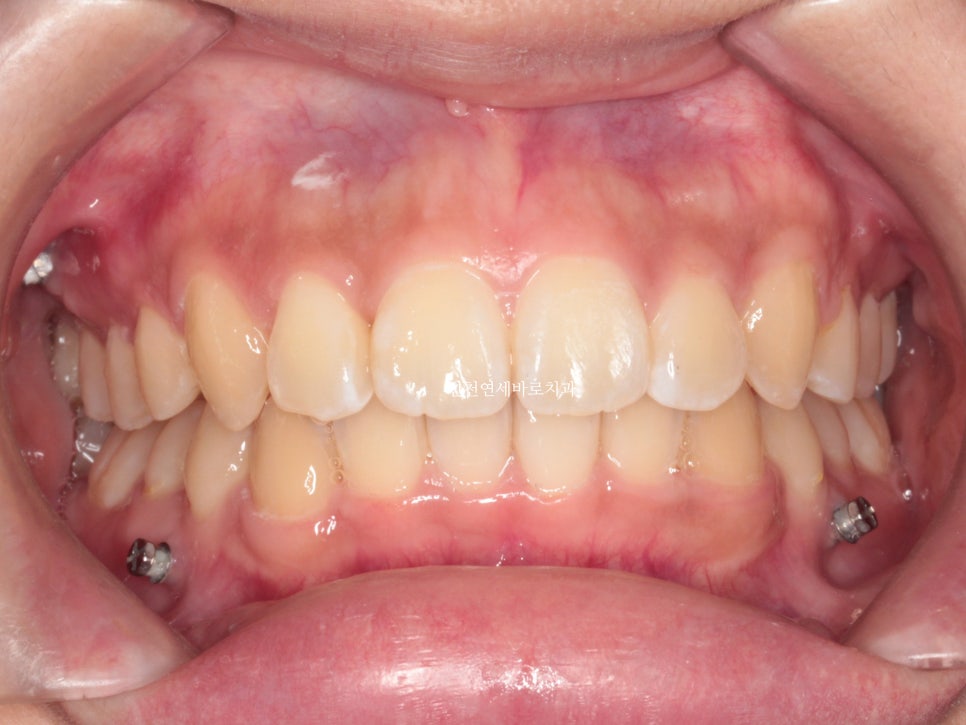 덧니 돌출입 중심선 비발치 교정 치료 후 2년 후 확인