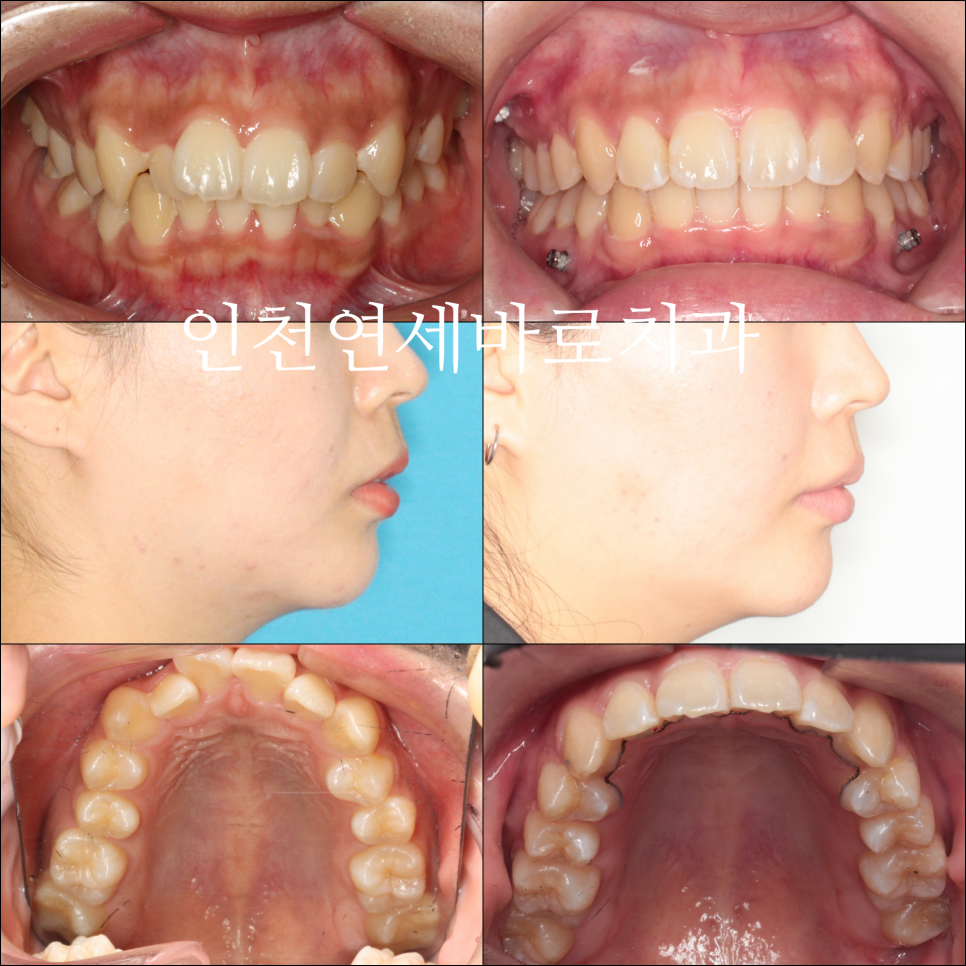덧니 돌출입 중심선 비발치 교정 치료 후 2년 후 확인