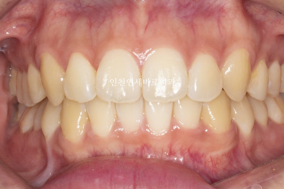 덧니 돌출입 중심선 비발치 교정 치료 후 2년 후 확인