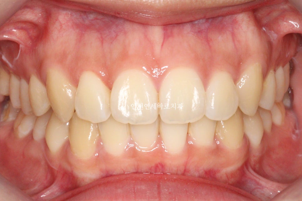 덧니 돌출입 중심선 비발치 교정 치료 후 2년 후 확인