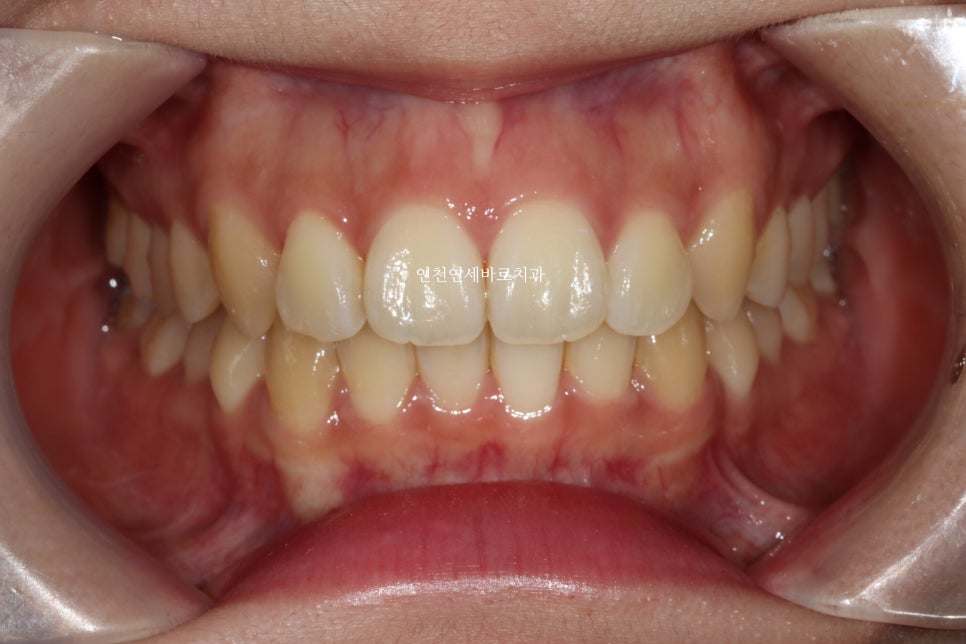 덧니 돌출입 중심선 비발치 교정 치료 후 2년 후 확인