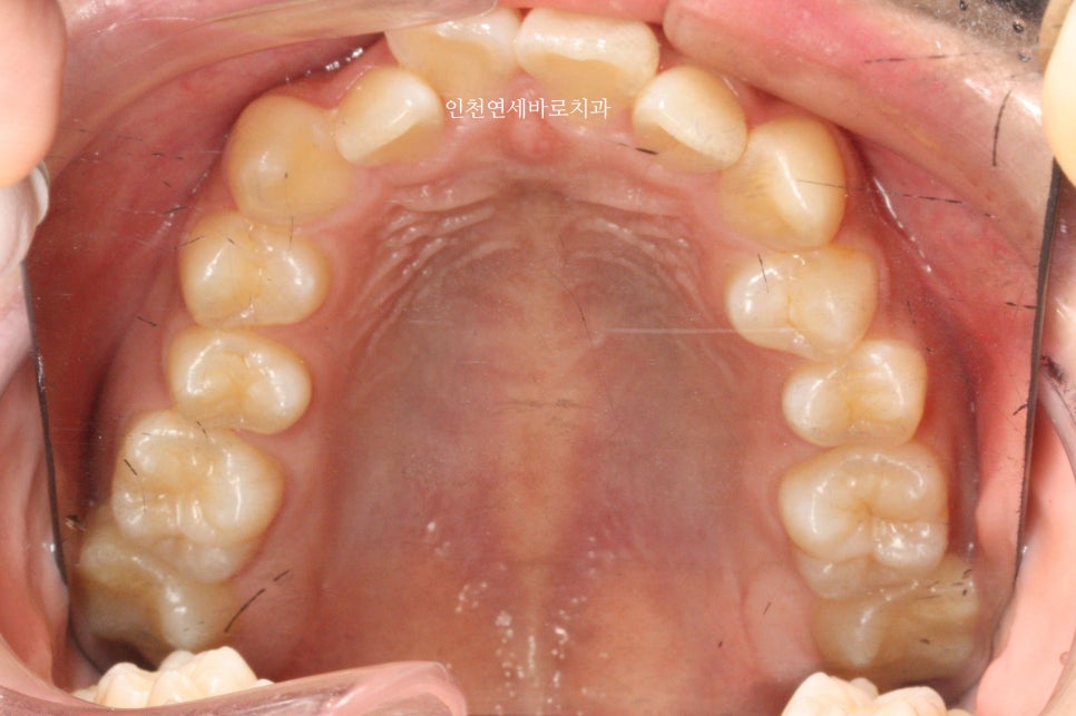 덧니 돌출입 중심선 비발치 교정 치료 후 2년 후 확인
