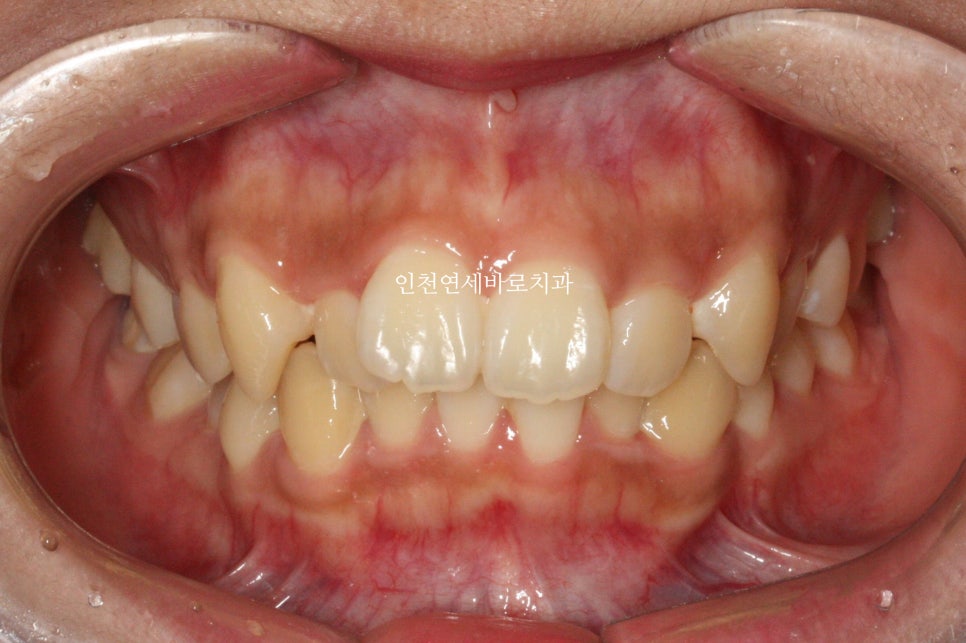 덧니 돌출입 중심선 비발치 교정 치료 후 2년 후 확인