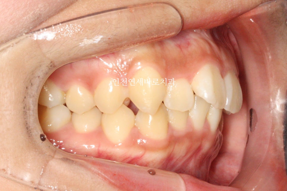 덧니 돌출입 중심선 비발치 교정 치료 후 2년 후 확인