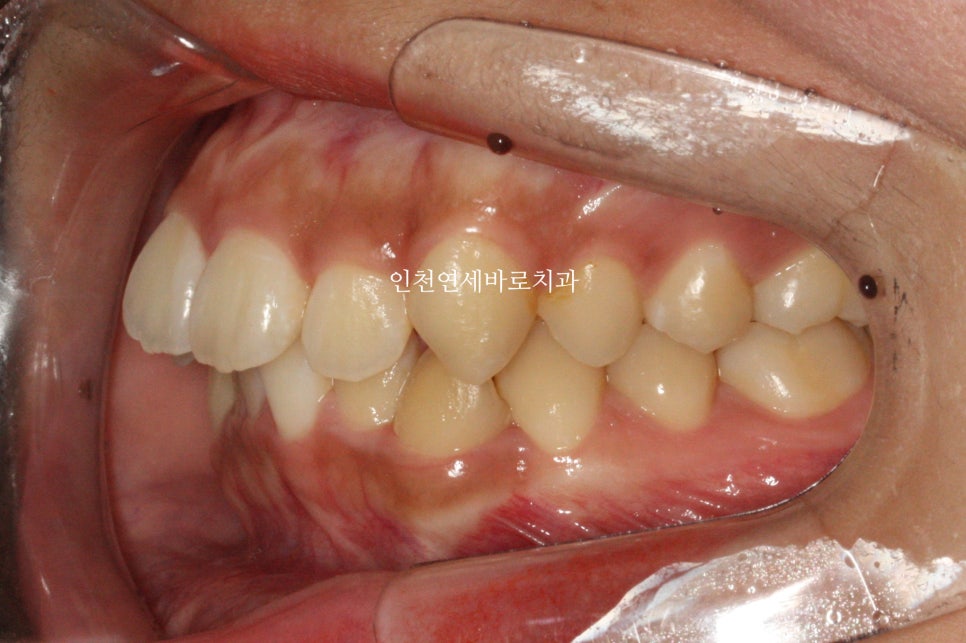 덧니 돌출입 중심선 비발치 교정 치료 후 2년 후 확인