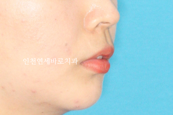 덧니 돌출입 중심선 비발치 교정 치료 후 2년 후 확인