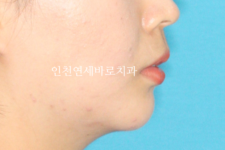 덧니 돌출입 중심선 비발치 교정 치료 후 2년 후 확인