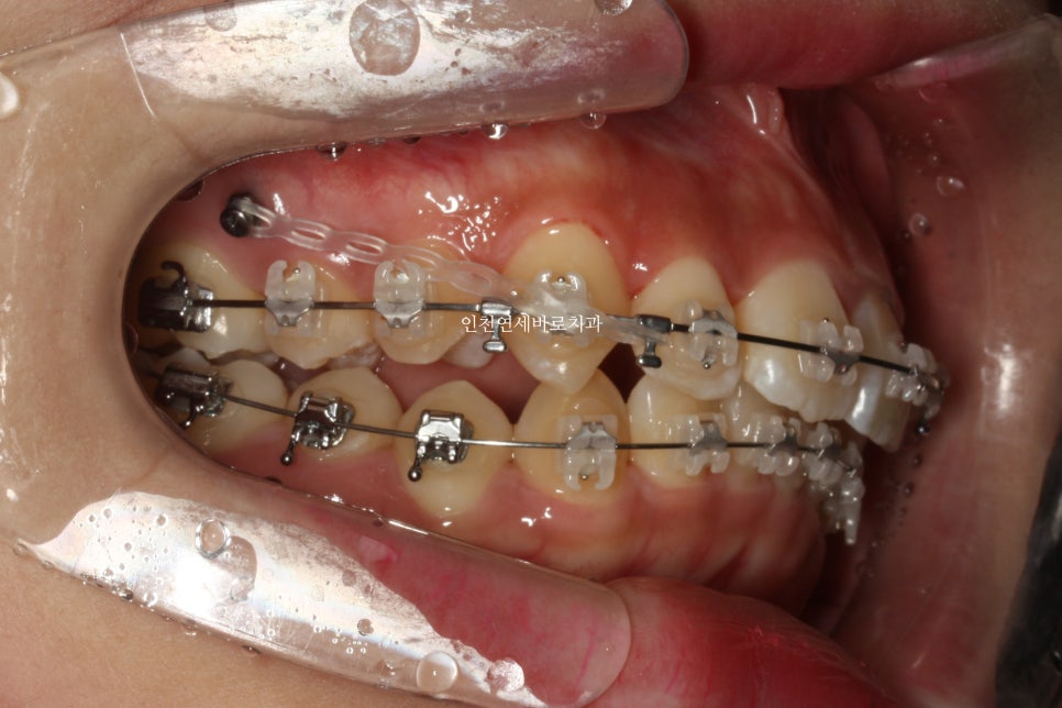 덧니 돌출입 중심선 비발치 교정 치료 후 2년 후 확인