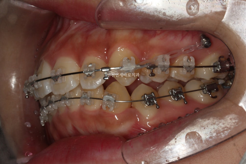 덧니 돌출입 중심선 비발치 교정 치료 후 2년 후 확인