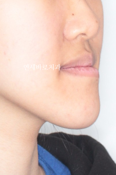 양악 수술 교정 전 후 그리고 장기관찰,  인천교정치과는 연세바로치과