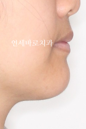 양악 수술 교정 전 후 그리고 장기관찰,  인천교정치과는 연세바로치과
