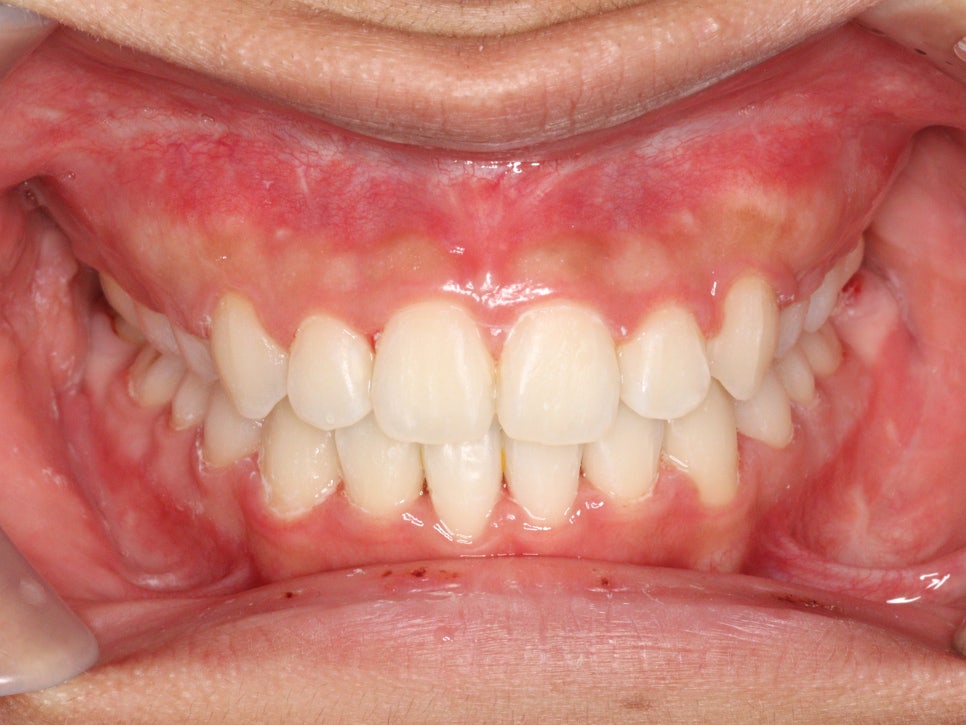 양악 수술 교정 전 후 그리고 장기관찰,  인천교정치과는 연세바로치과