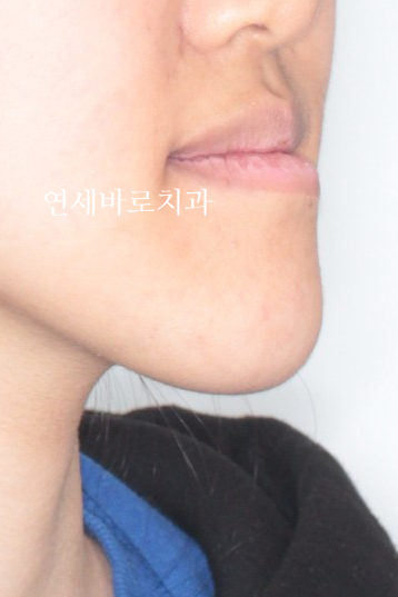 양악 수술 교정 전 후 그리고 장기관찰,  인천교정치과는 연세바로치과