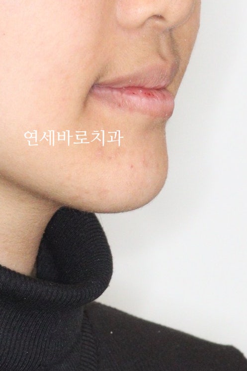양악 수술 교정 전 후 그리고 장기관찰,  인천교정치과는 연세바로치과