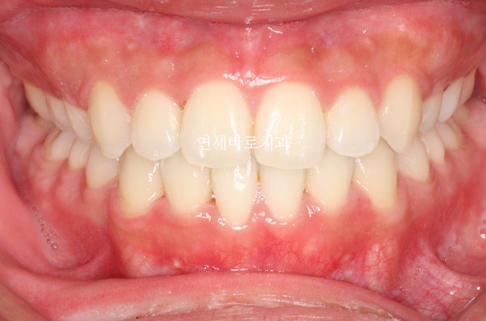 양악 수술 교정 전 후 그리고 장기관찰,  인천교정치과는 연세바로치과