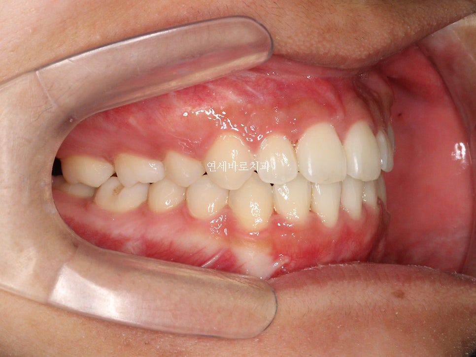 양악 수술 교정 전 후 그리고 장기관찰,  인천교정치과는 연세바로치과