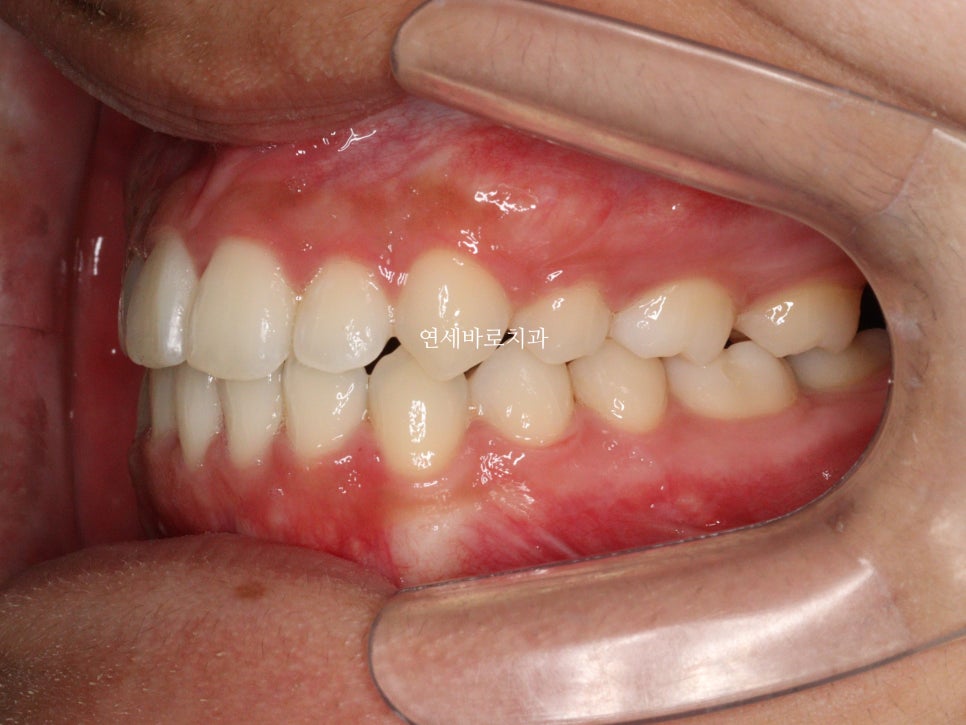 양악 수술 교정 전 후 그리고 장기관찰,  인천교정치과는 연세바로치과