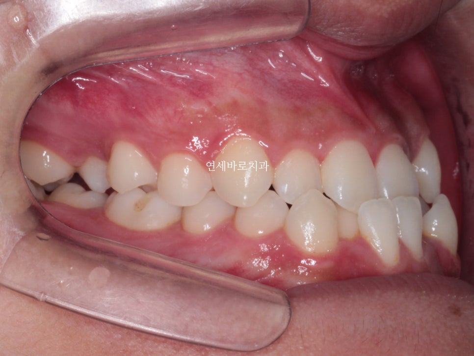 양악 수술 교정 전 후 그리고 장기관찰,  인천교정치과는 연세바로치과