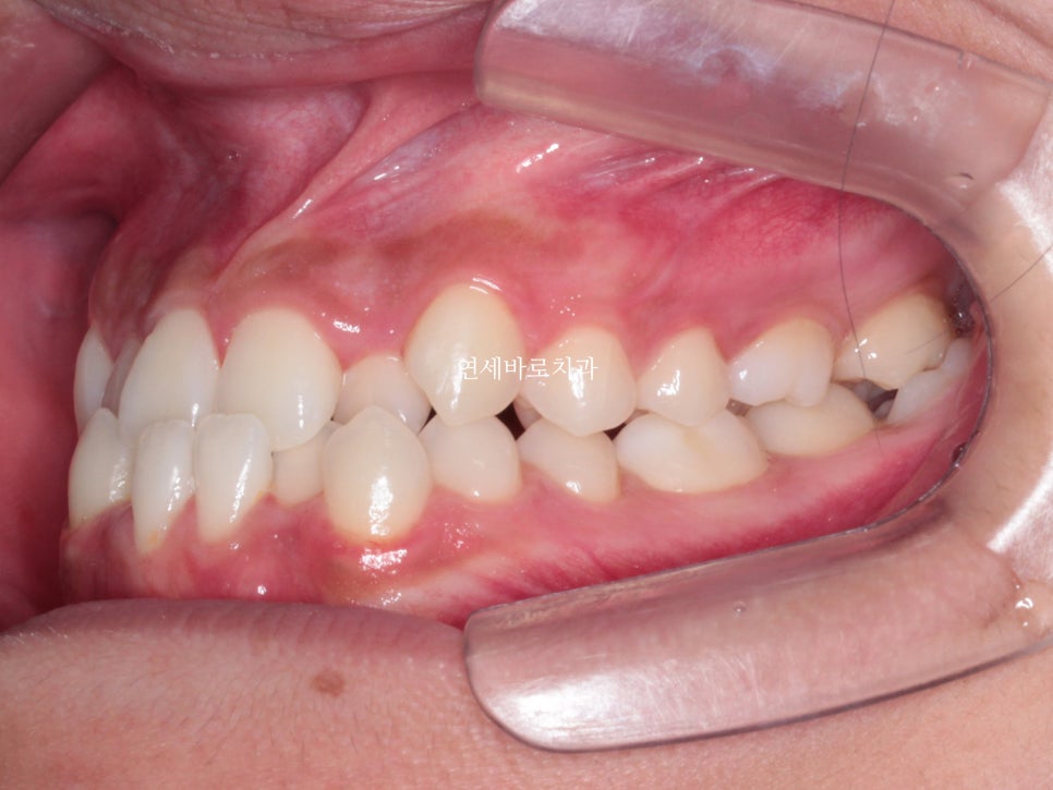양악 수술 교정 전 후 그리고 장기관찰,  인천교정치과는 연세바로치과
