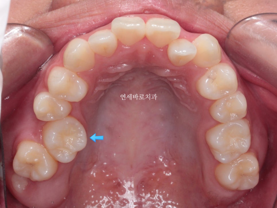 양악 수술 교정 전 후 그리고 장기관찰,  인천교정치과는 연세바로치과
