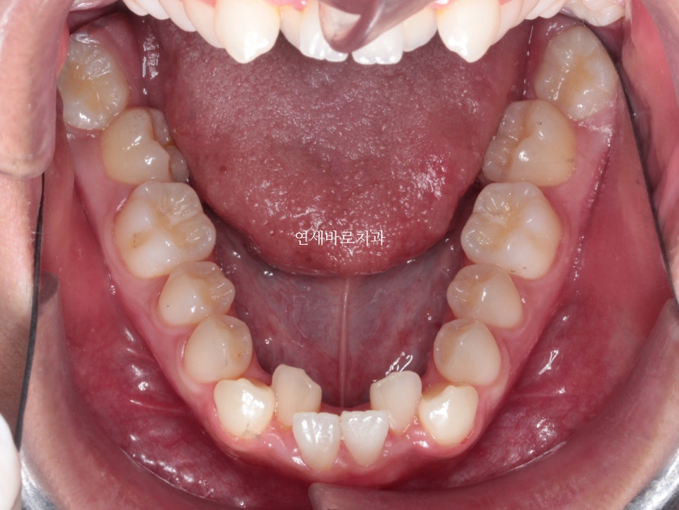 양악 수술 교정 전 후 그리고 장기관찰,  인천교정치과는 연세바로치과