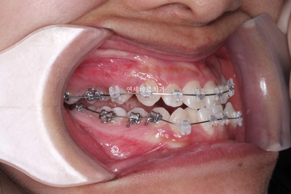 양악 수술 교정 전 후 그리고 장기관찰,  인천교정치과는 연세바로치과