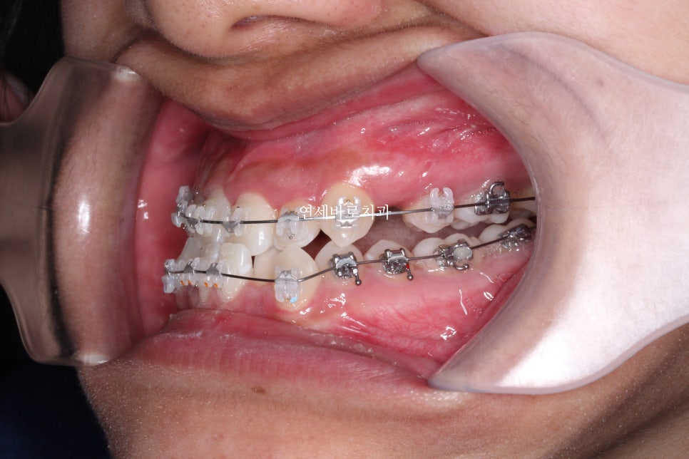 양악 수술 교정 전 후 그리고 장기관찰,  인천교정치과는 연세바로치과