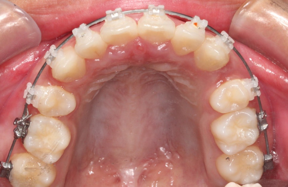 양악 수술 교정 전 후 그리고 장기관찰,  인천교정치과는 연세바로치과