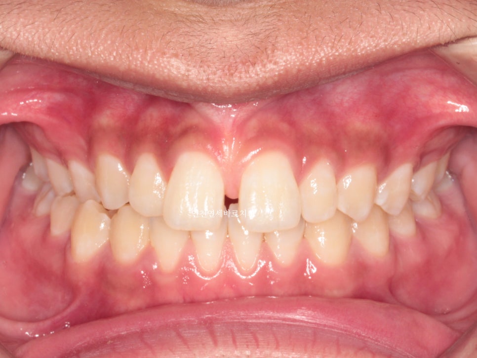 인천 인비절라인 치료 전 후 비교 블루다이아몬드&글로벌등재