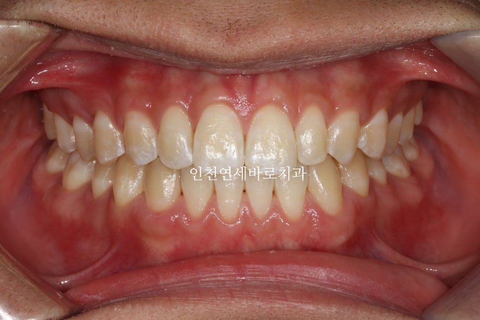 인천 인비절라인 치료 전 후 비교 블루다이아몬드&글로벌등재