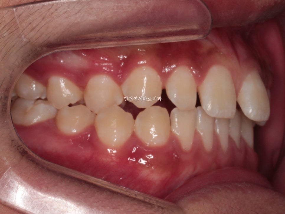 인천 인비절라인 치료 전 후 비교 블루다이아몬드&글로벌등재