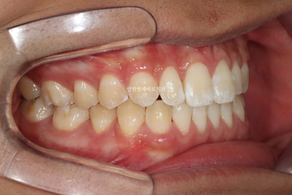 인천 인비절라인 치료 전 후 비교 블루다이아몬드&글로벌등재