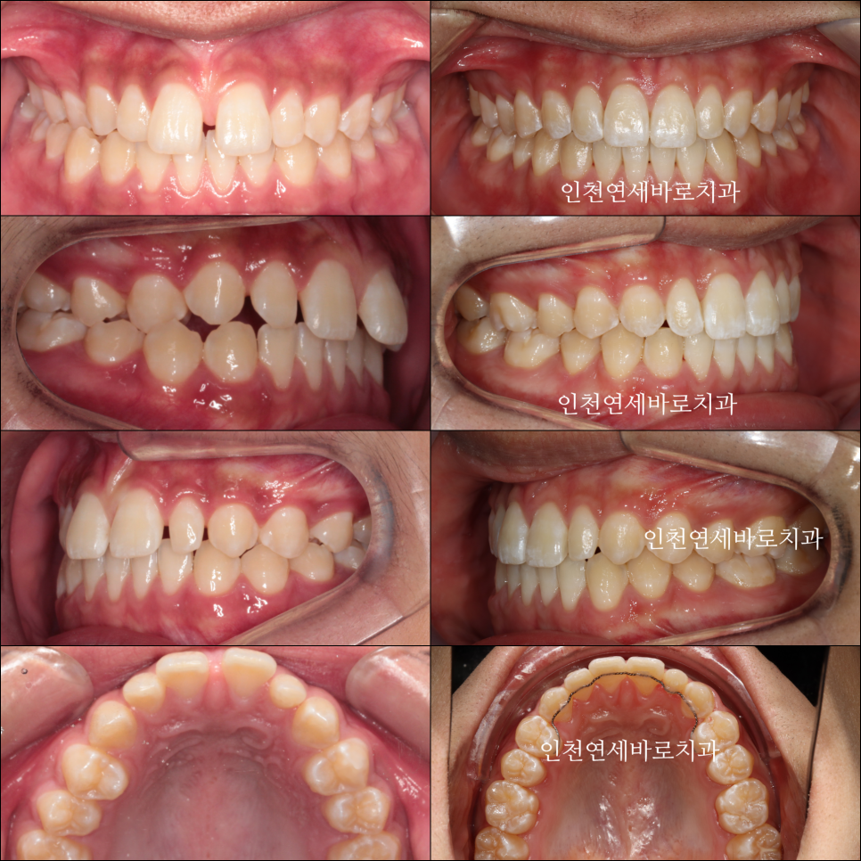 인천 인비절라인 치료 전 후 비교 블루다이아몬드&글로벌등재