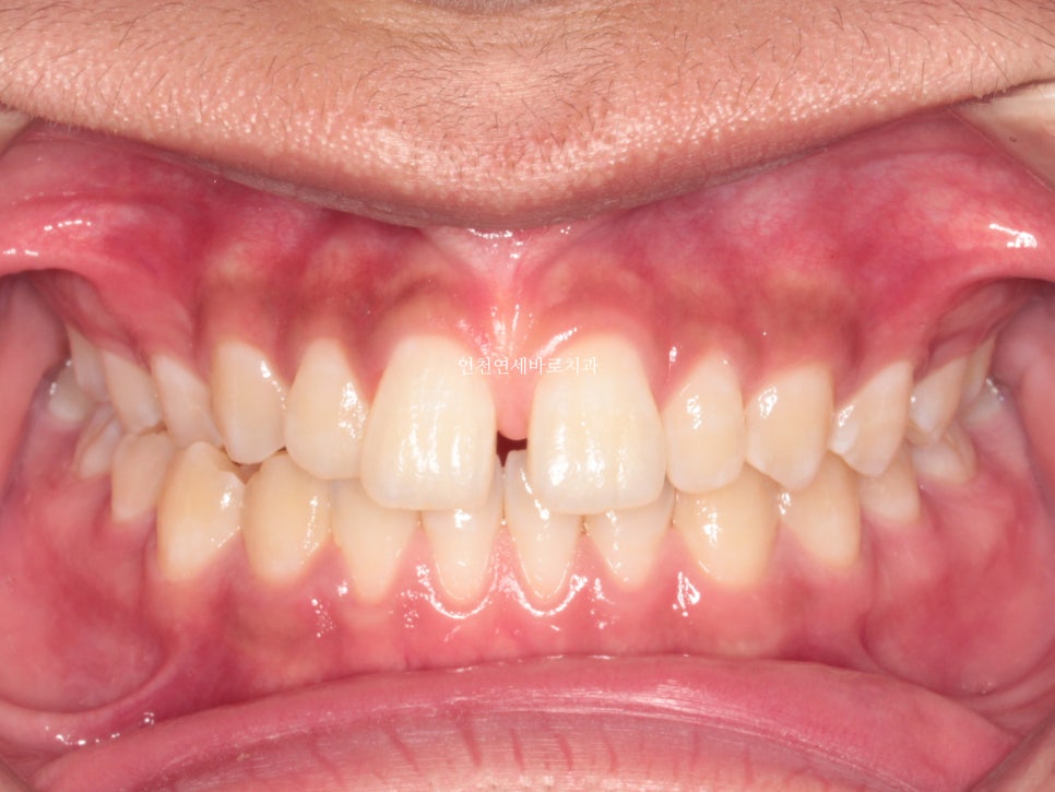 인천 인비절라인 치료 전 후 비교 블루다이아몬드&글로벌등재