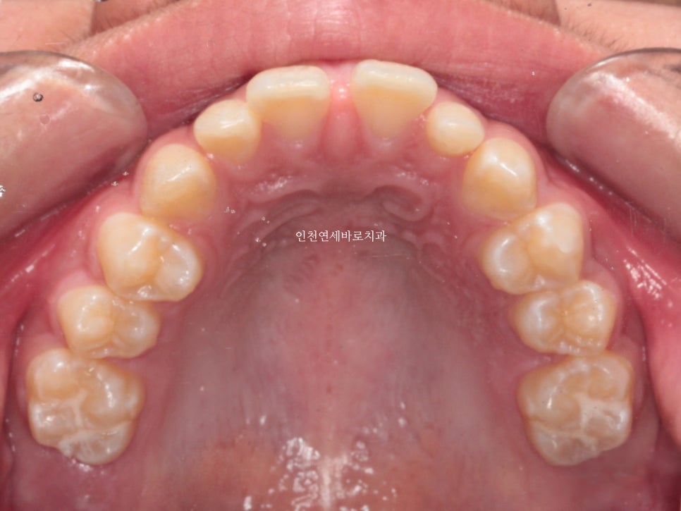 인천 인비절라인 치료 전 후 비교 블루다이아몬드&글로벌등재