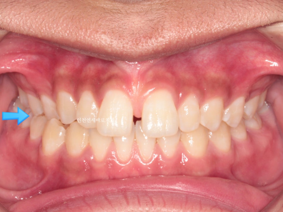 인천 인비절라인 치료 전 후 비교 블루다이아몬드&글로벌등재