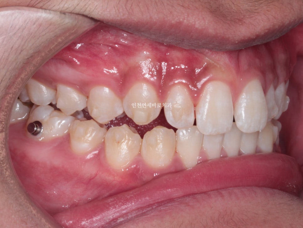 인천 인비절라인 치료 전 후 비교 블루다이아몬드&글로벌등재