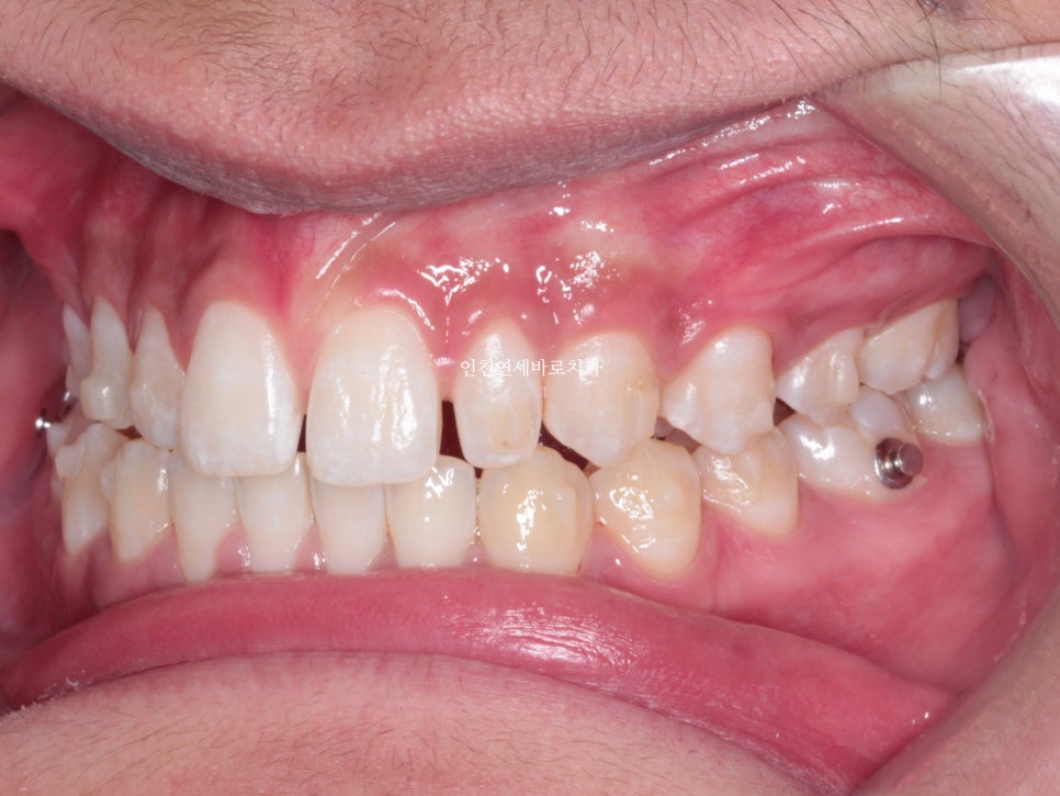 인천 인비절라인 치료 전 후 비교 블루다이아몬드&글로벌등재