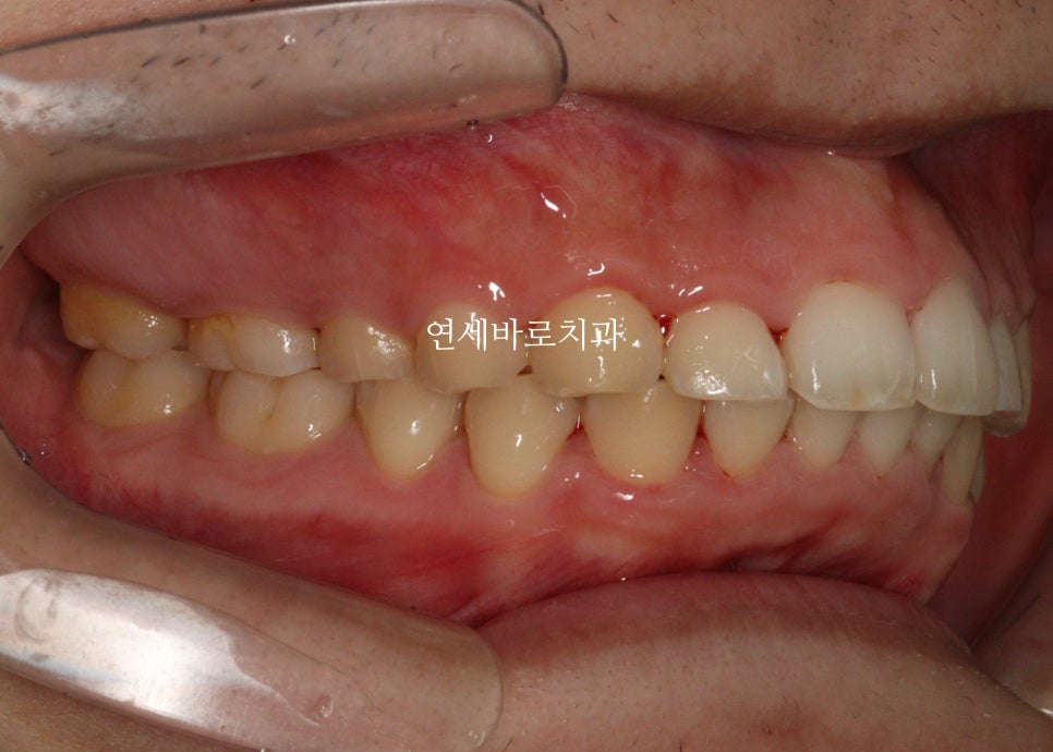 비발치로 얼마나 입을 넣을 수 있을까