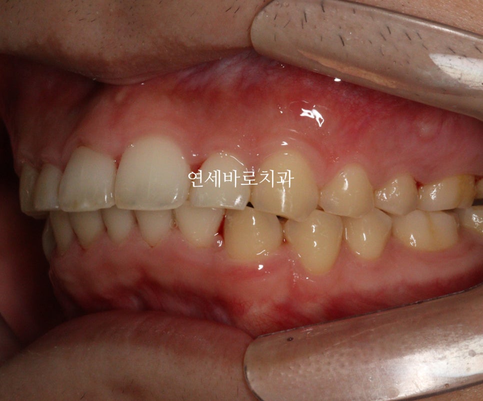 비발치로 얼마나 입을 넣을 수 있을까