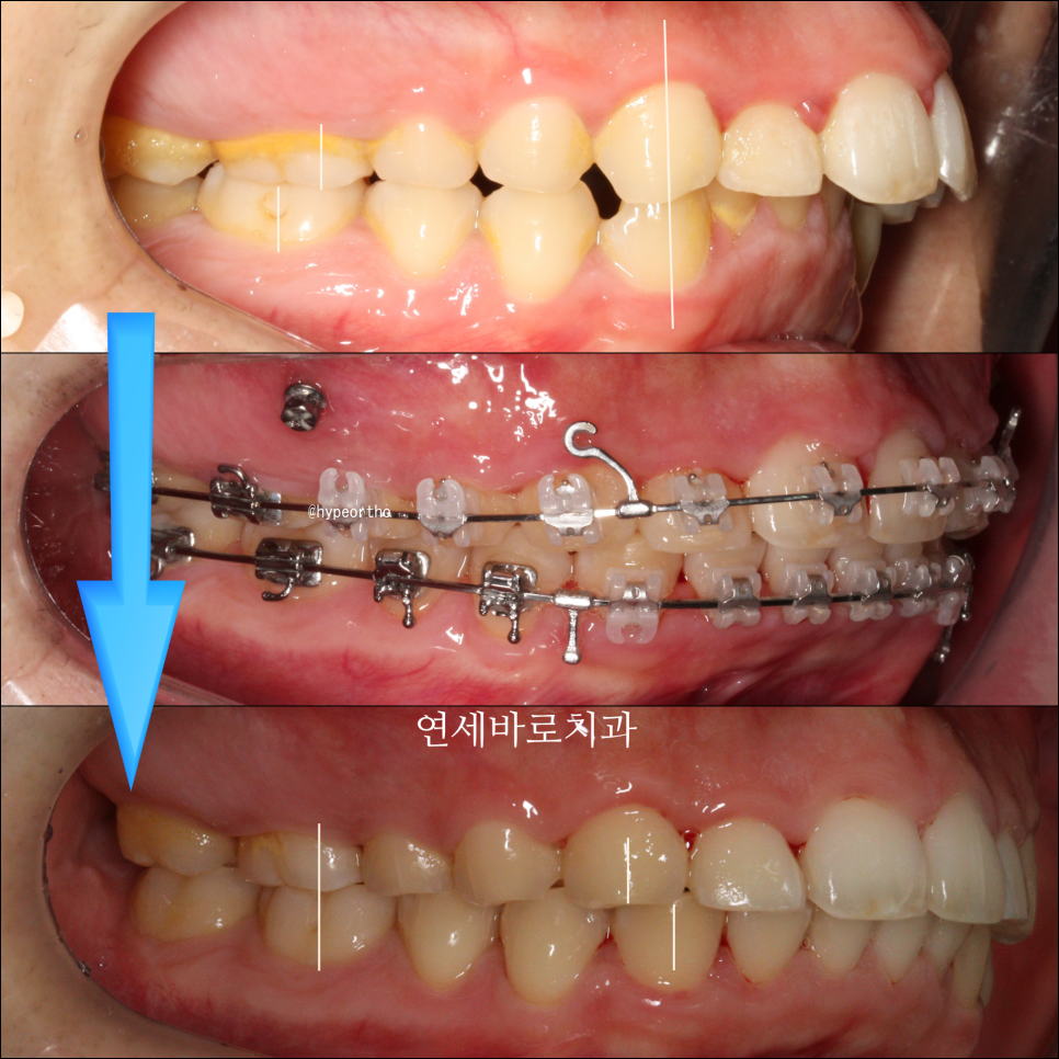 비발치로 얼마나 입을 넣을 수 있을까