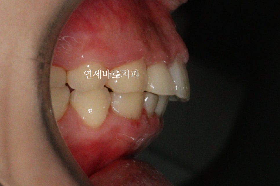 비발치로 얼마나 입을 넣을 수 있을까