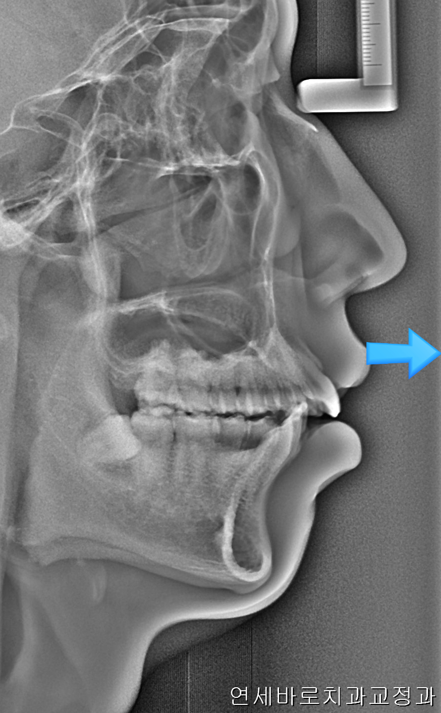 비발치로 얼마나 입을 넣을 수 있을까