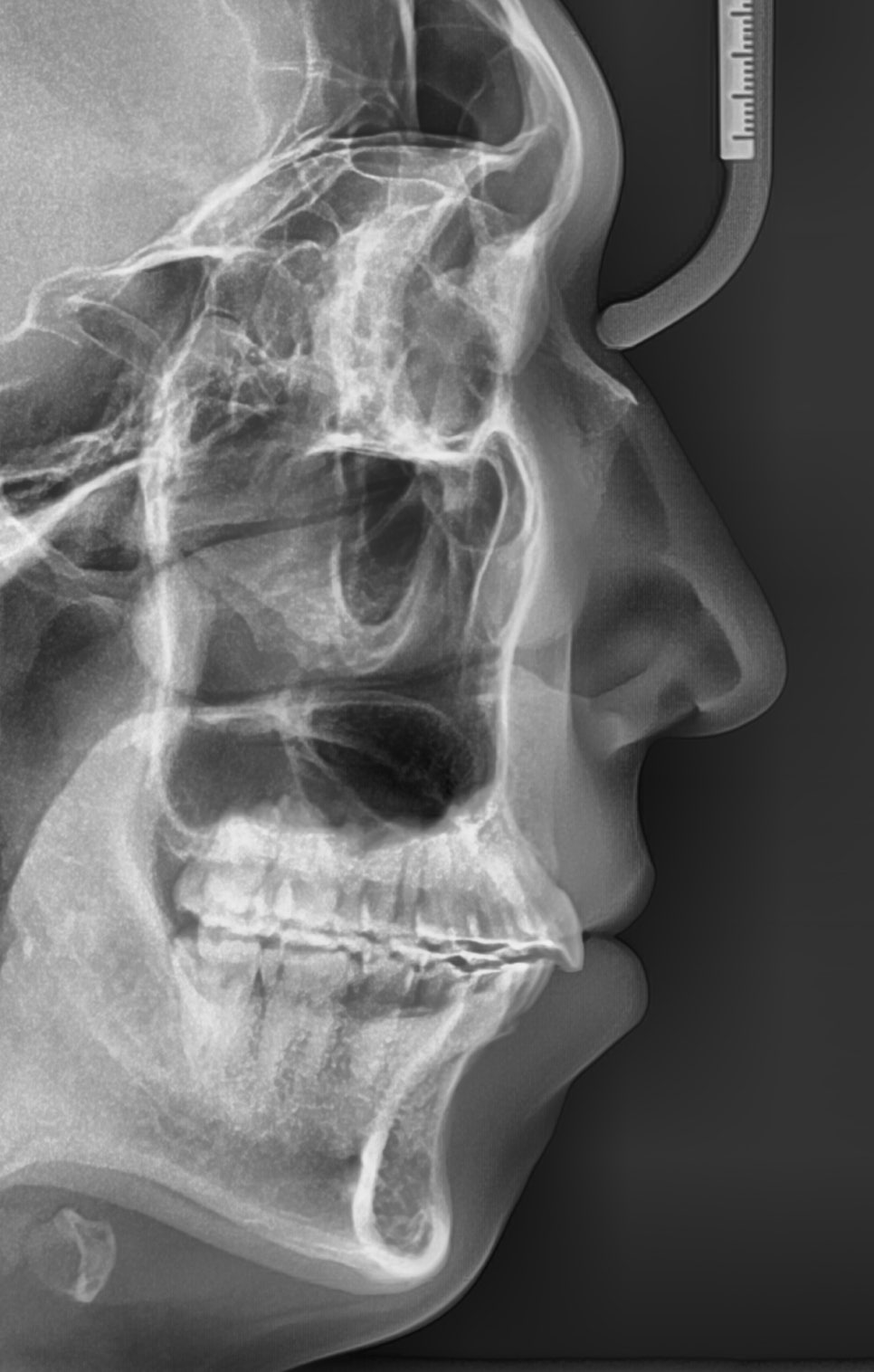 비발치로 얼마나 입을 넣을 수 있을까