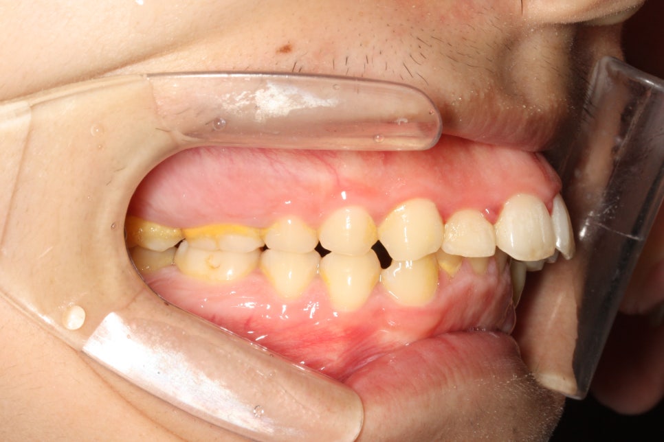 비발치로 얼마나 입을 넣을 수 있을까