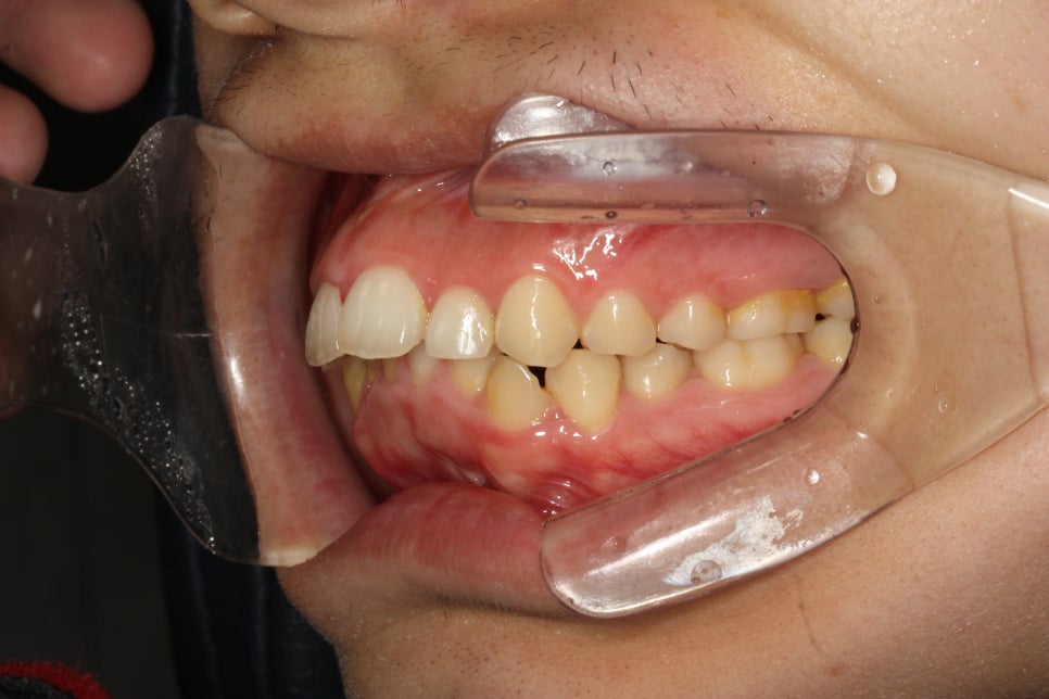 비발치로 얼마나 입을 넣을 수 있을까