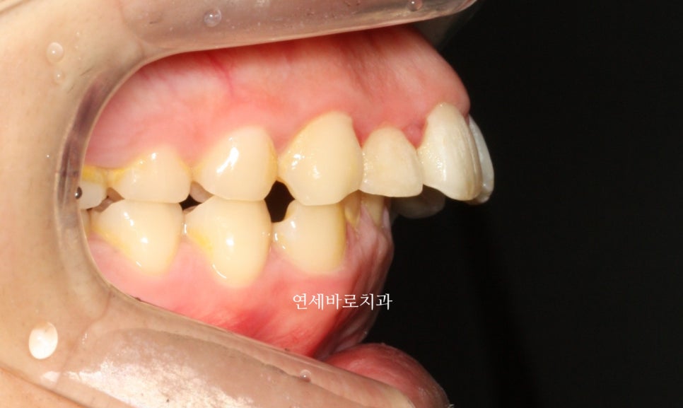 비발치로 얼마나 입을 넣을 수 있을까