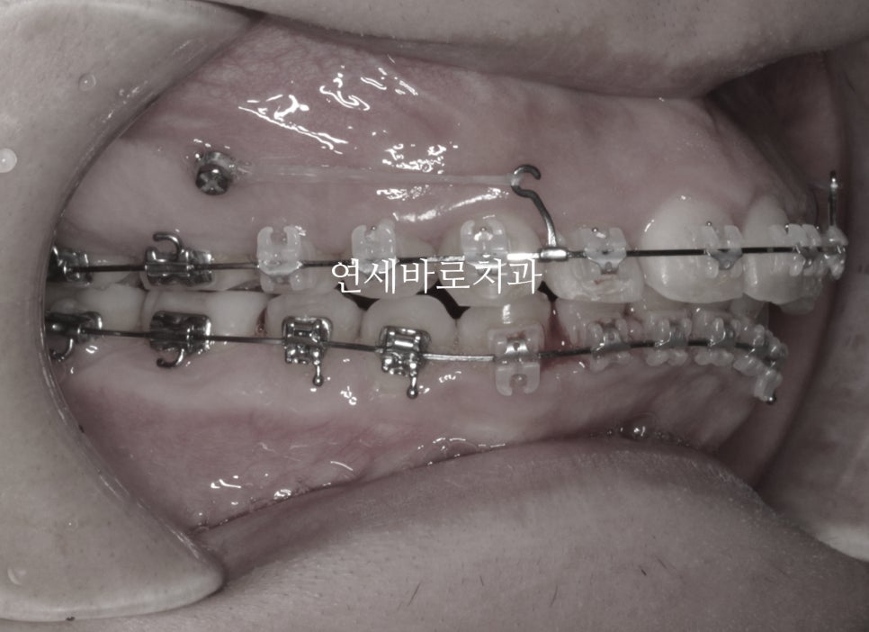 비발치로 얼마나 입을 넣을 수 있을까