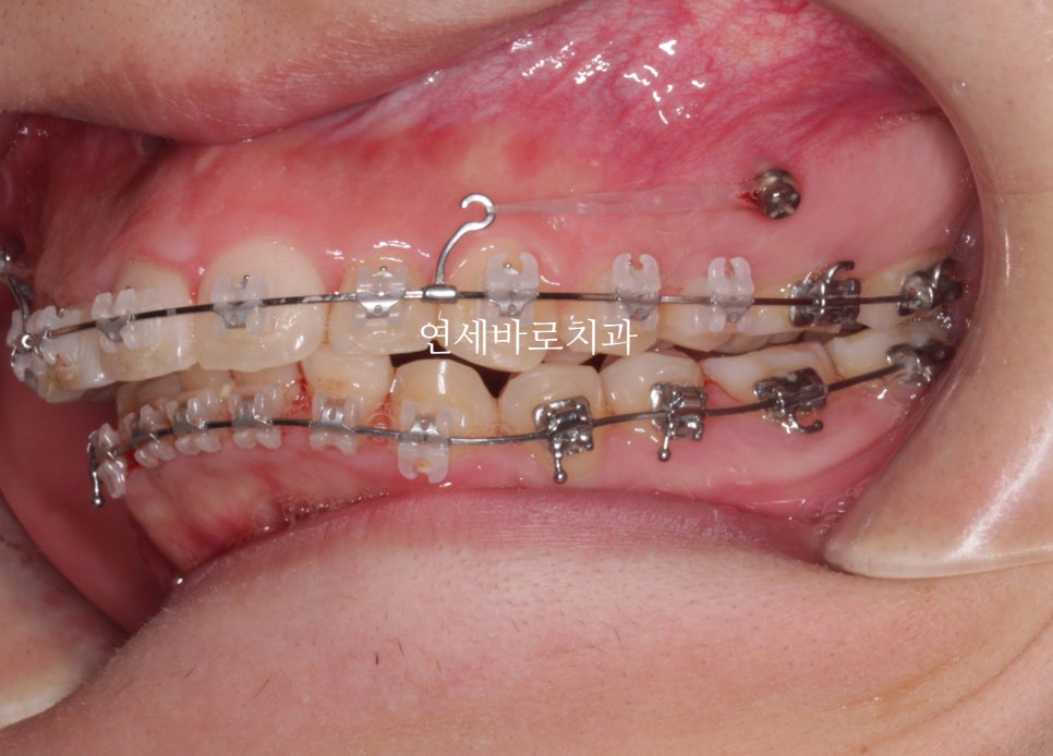 비발치로 얼마나 입을 넣을 수 있을까