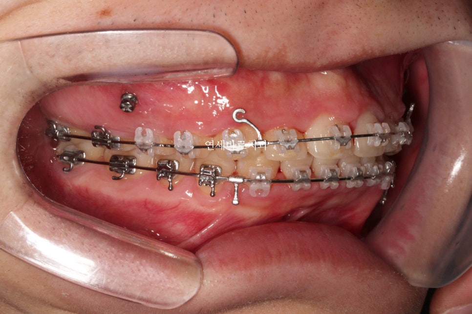 비발치로 얼마나 입을 넣을 수 있을까